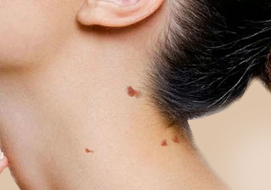 Occurrence of papillomas on the neck after activation of HPV in the body