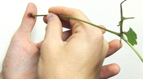 Cauterization of papillomas on the finger with celandine juice