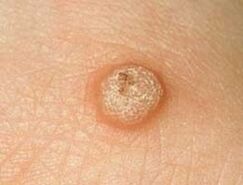 vulgaris wart on the skin