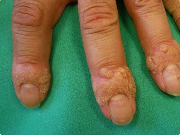 how to remove warts on fingers