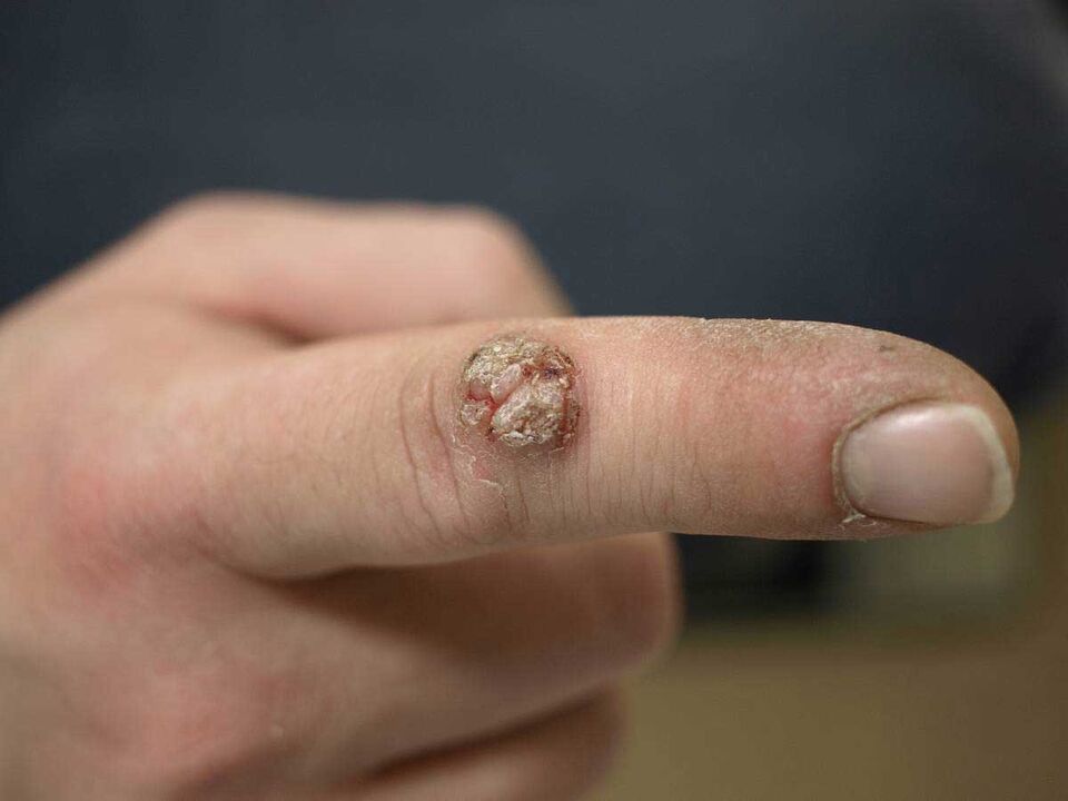 A large wart on the finger that needs to be removed