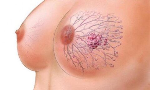 Papilla chest