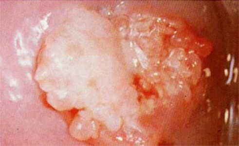 Sonedid Cervix
