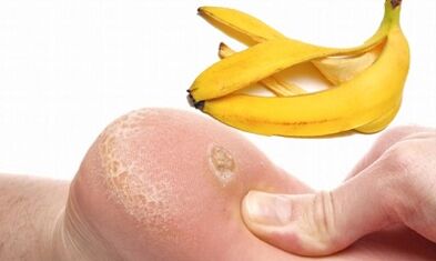 Banana Peel for Treating Plantara Nipples