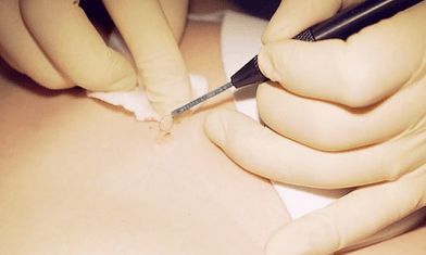 Surgical removal of plantar nipple