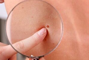 reasons for the appearance of papillomas on the human body