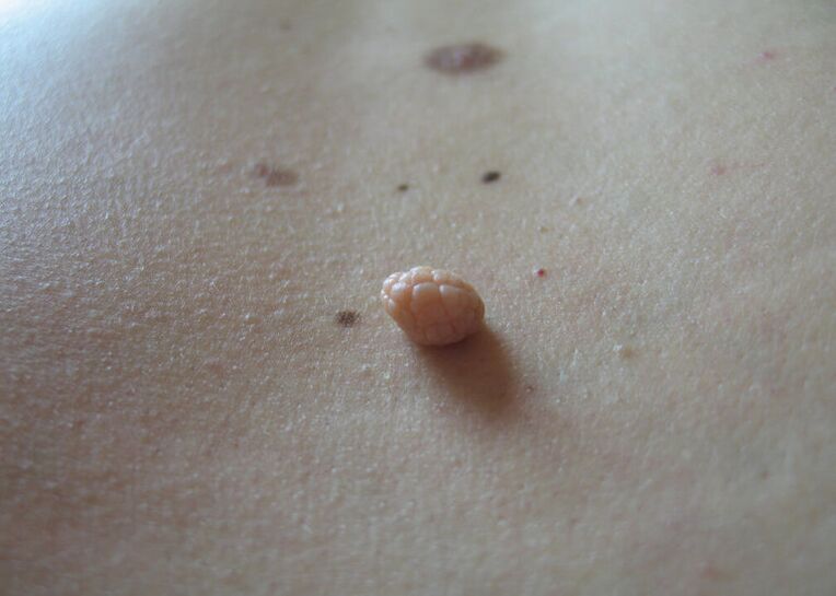 papillomas on the human body
