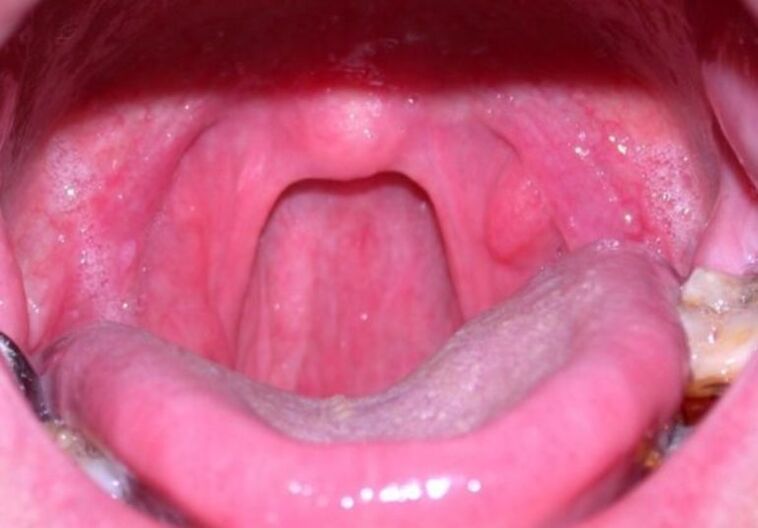 papilloma in the throat