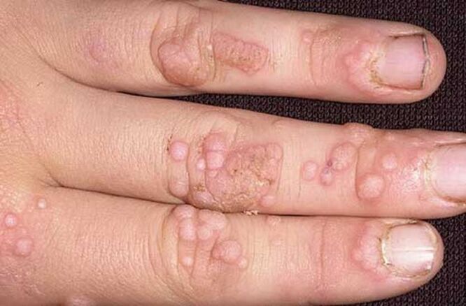 simple papillomas on the hand