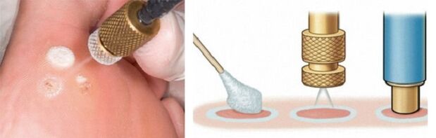 cryodestruction as a method for papilloma removal
