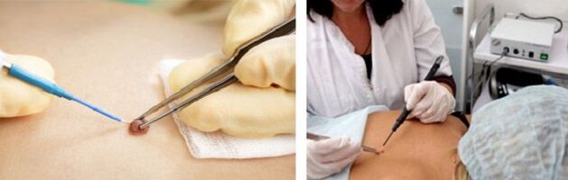 electrocoagulation as a method of papilloma removal