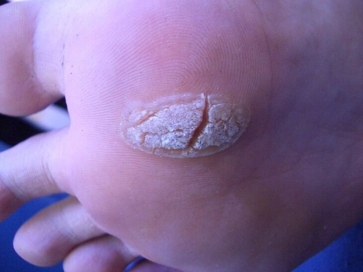 a wart on the skin of the foot