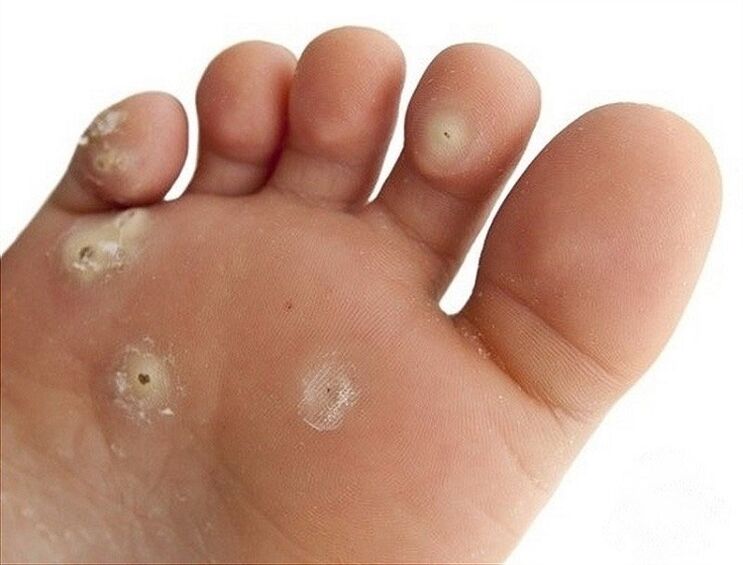 plantar warts