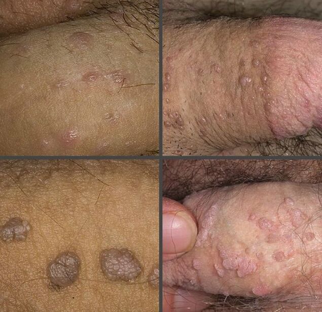 Types of warts