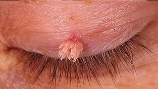 A pointed nipple on the eyelid