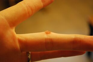 A wart on a finger