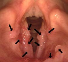 Papillomas of the larynx
